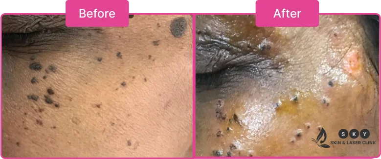 Before_and_After_for_Laser_Treatment_for_DPN_Scars_Before_and_After,