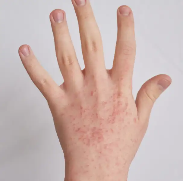 Eczema_banner_image