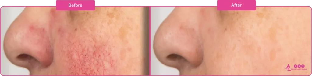 Eczema_before_after_