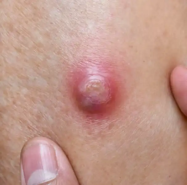 Epidermoid_Cyst_Removal_banner_image