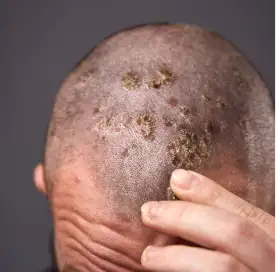 Scalp_Ringworm
