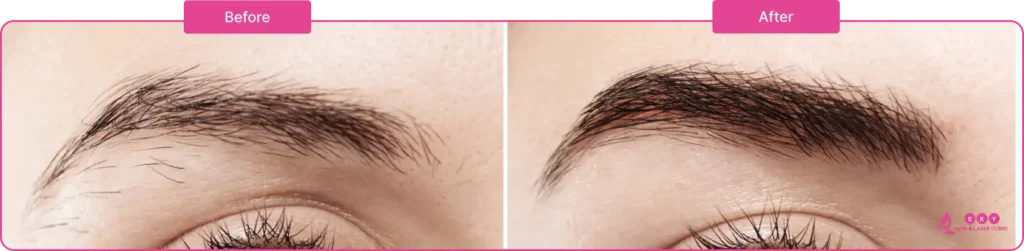 before_after_microblading