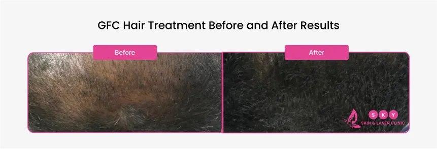 before_after_of_GRC_PRP