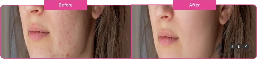 before_after_open_pores