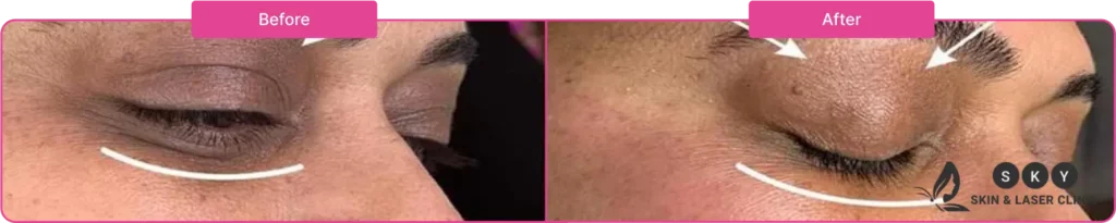 Before_and_After_ Dark Under_Eye_Treatment,