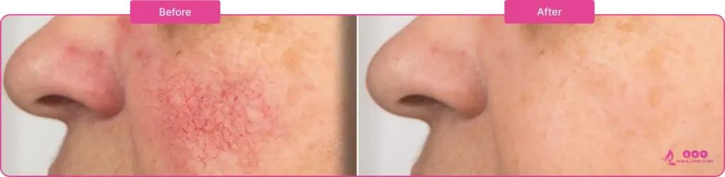 before_and_after_fungal-infection