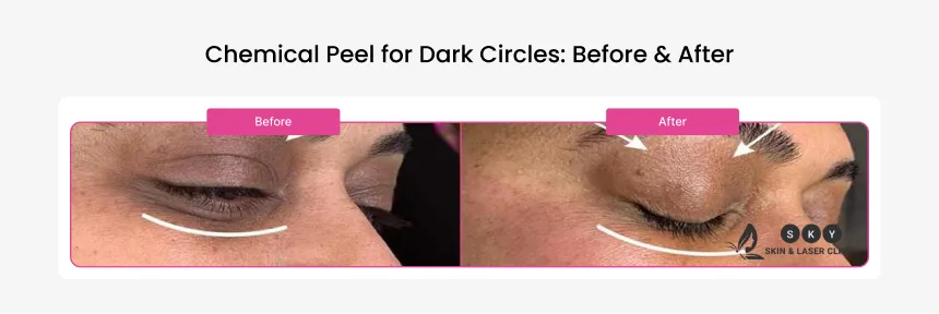 before_and_after_results_of_dark_circle