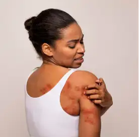 Excess Sweating (Hyperhidrosis)