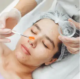 chemical_peel_for_pores