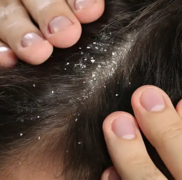 Dandruff_Treatment_in_Chennai