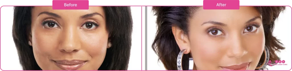 derma_filler_before_after