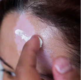 medical_treatment_for_vitiligo