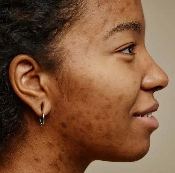 melasma_treatment_banner_image_page