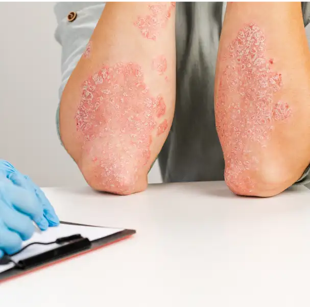 psoraisis_banner_image