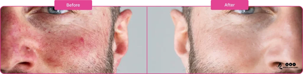 psoriasis_before_and_after_images