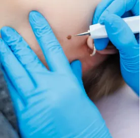 skin_tag_removal_clinic_near _me