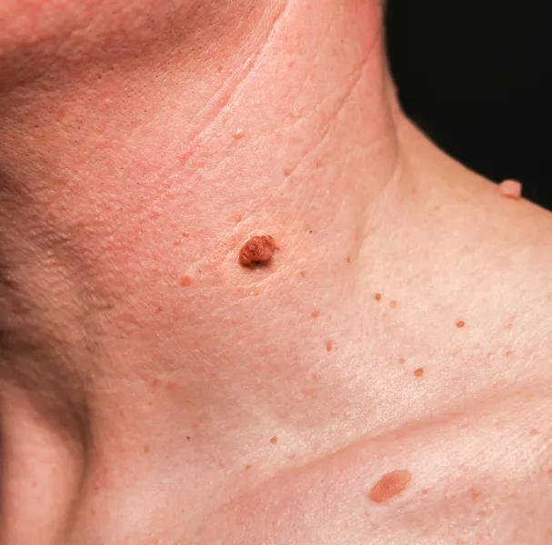 Skin_Tag_Removal_in_Chennai