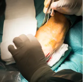 surgical_treatment_for_vitiligo