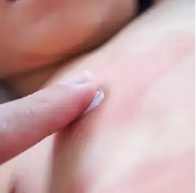 topical_medication-melasma