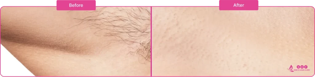underarm_hair_removal_before_after