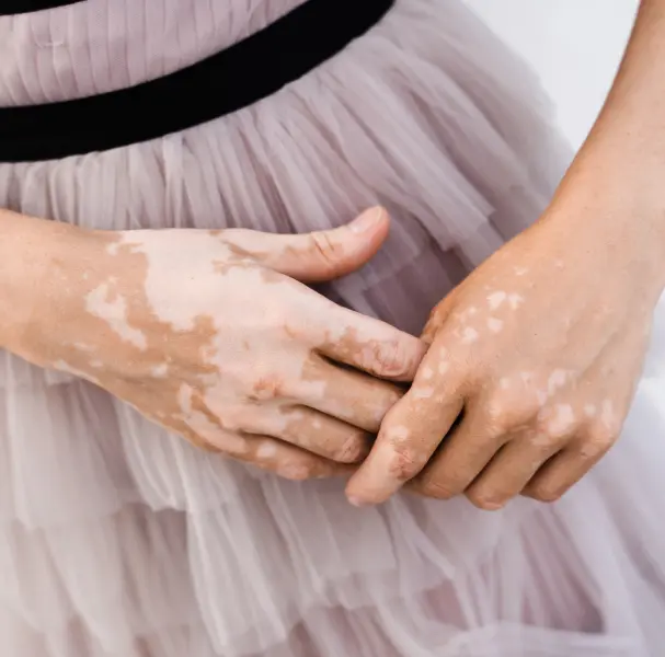 vitiligo_banner_image
