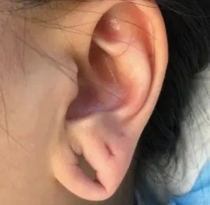 earlobe_repair
