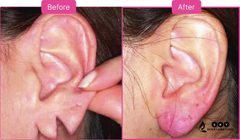earlobe_repair_before_and_after-1