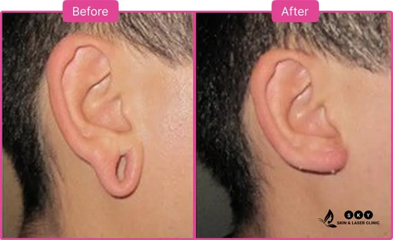 earlobe_repair_before_and_after-2
